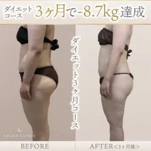 脂肪冷却施術の症例写真