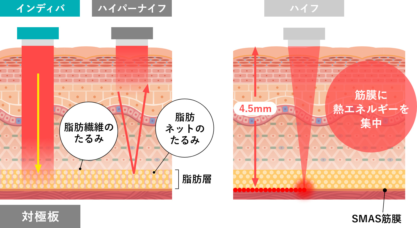 インディバ インディバとは？痩身効果や仕組みを解説｜人気サロンのWEB予約も可