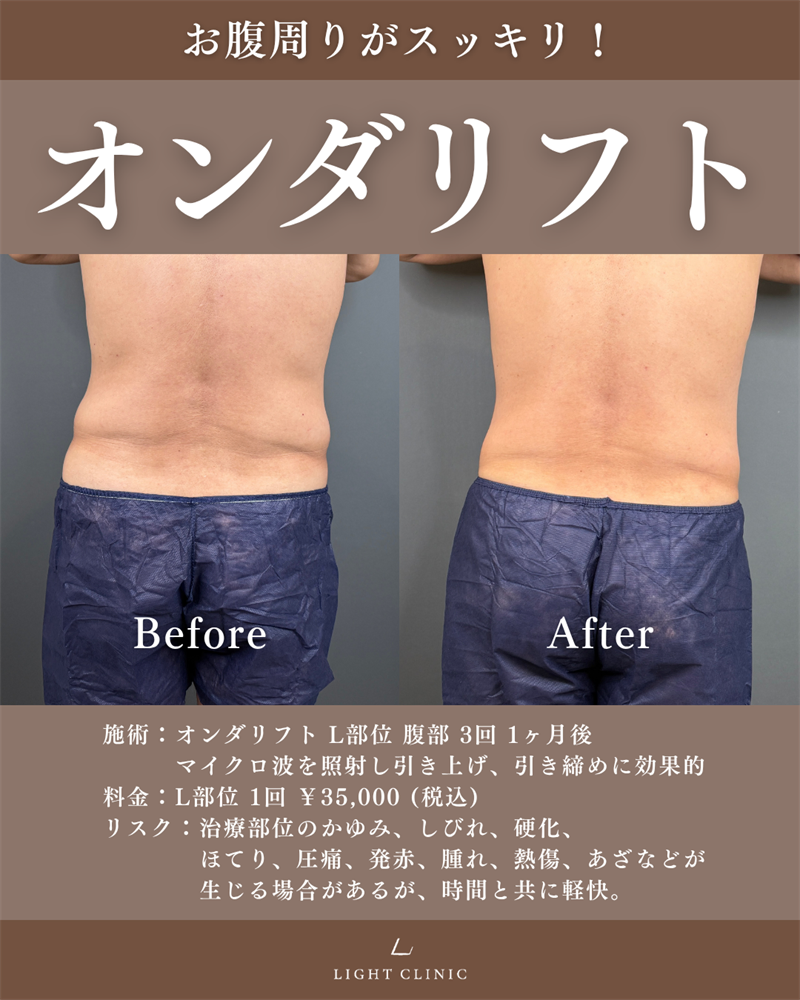 20代男性 腹部のオンダリフト