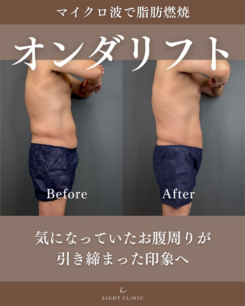 20代男性 腹部のオンダリフト
