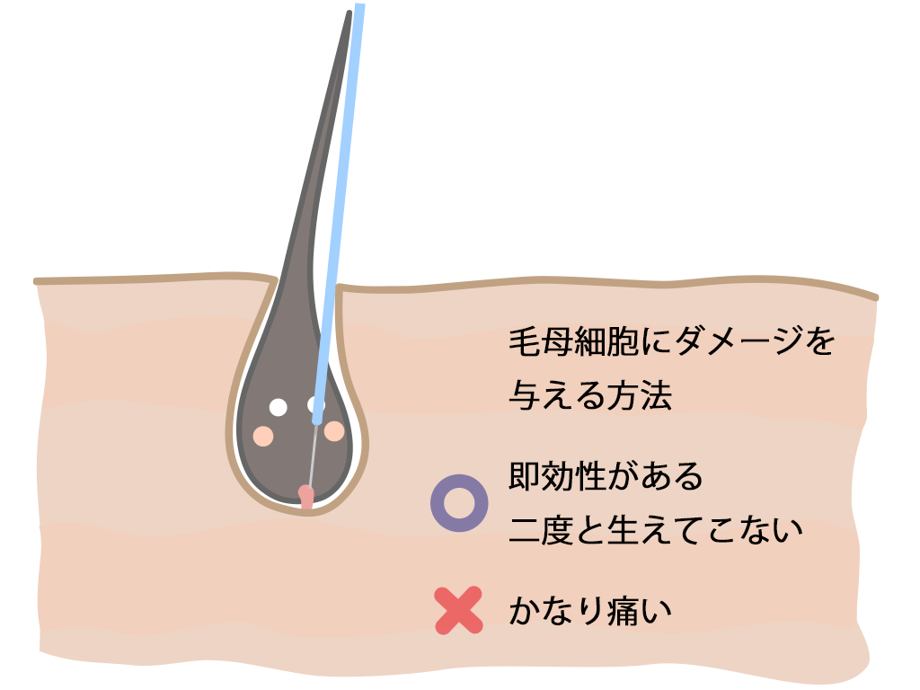 【大阪・新宿・名古屋】白髪・眉毛・タトゥーもOK！✨ 諦めていた毛を卒業する「痛くない」ニードル脱毛 💎