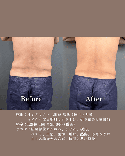 オンダリフトの腹部施術ビフォーアフター