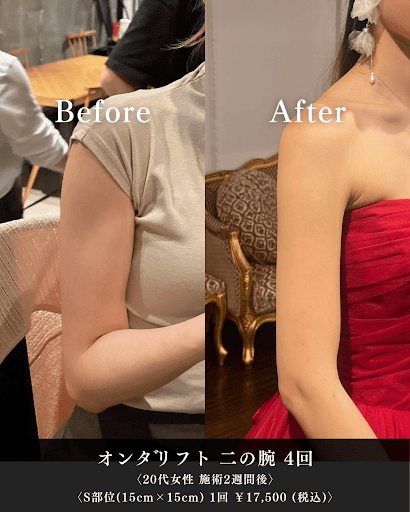 オンダリフトの二の腕施術ビフォーアフター